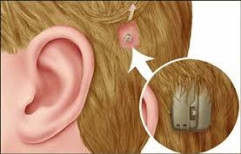 Bone Anchored Hearing Aids Trial by The Ent Clinic