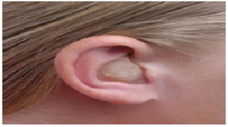 Siemens Intuis 2 Itc Hearing Aid by Digital Hearing Aid Centre